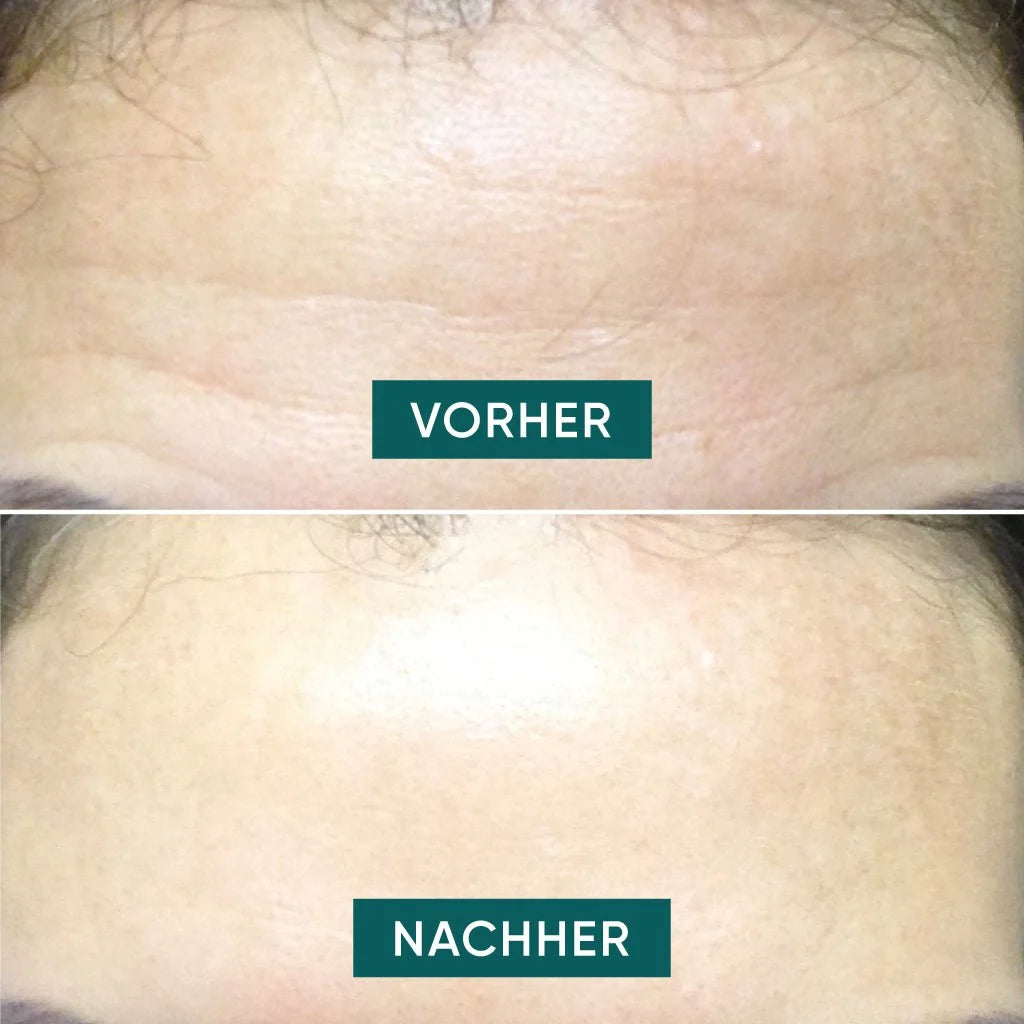 Reusable Patches for the forehead Fantastic forehead 1 reusable patch