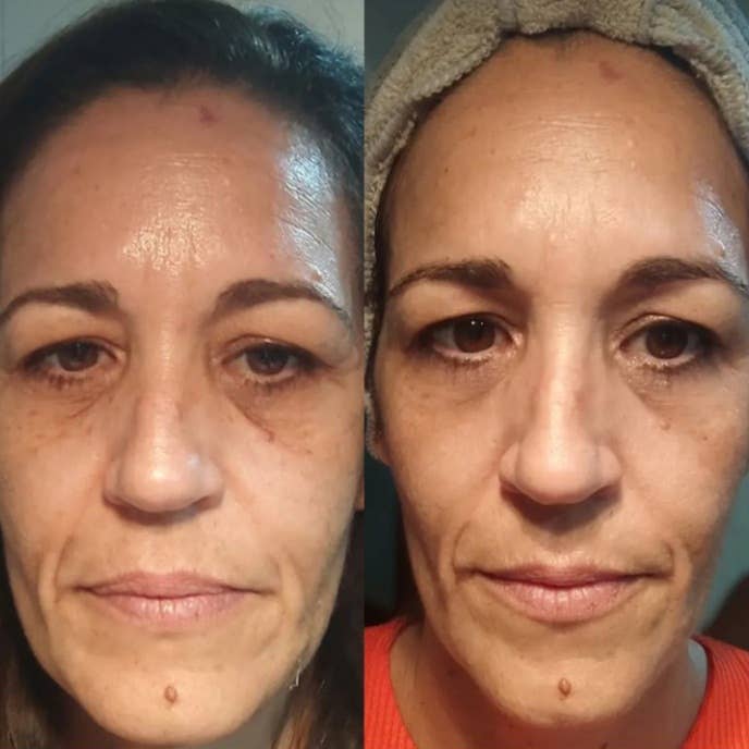 Beautical Microneedle Eye Patches