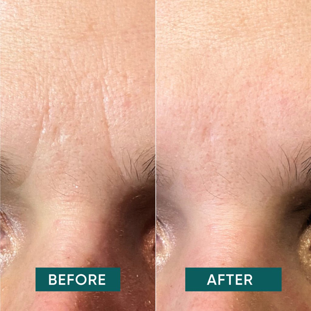 Down the frown Facial patches for the forehead 100 units