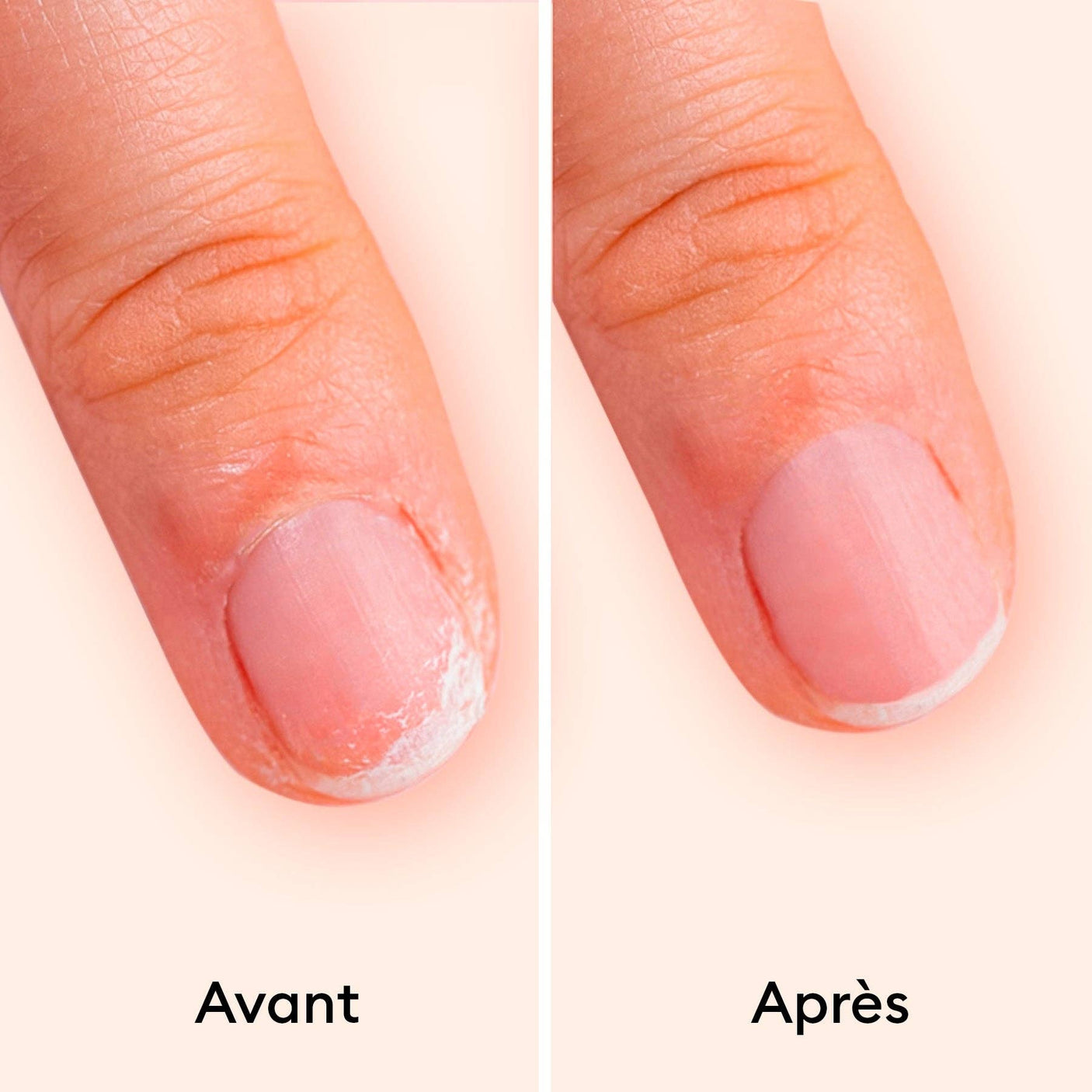 Resultado real antes y después del tratamiento con Kératine Booster en uñas descamadas.