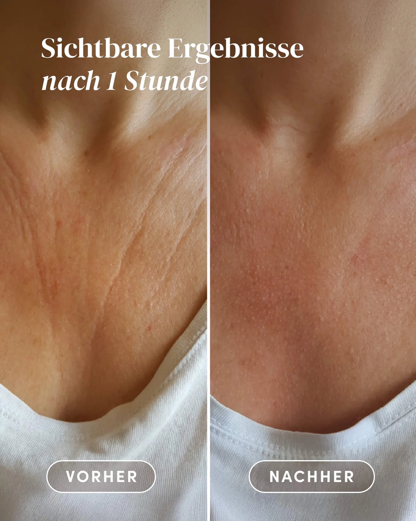 Detalle del pad de silicona de grado médico para cuello y escote con ácido hialurónico