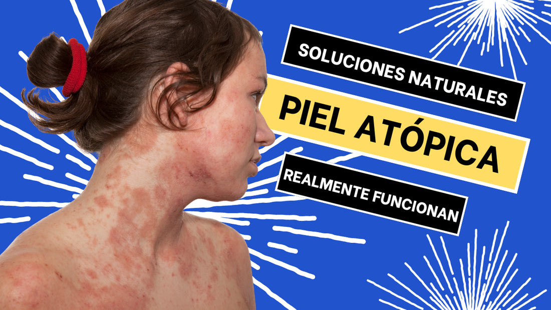 Todo lo Que Debes Saber Sobre la Piel Atópica y Cómo Cuidarla