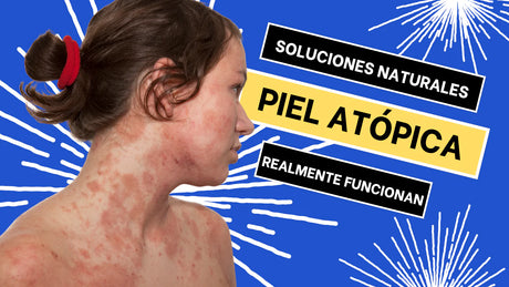 Todo lo Que Debes Saber Sobre la Piel Atópica y Cómo Cuidarla