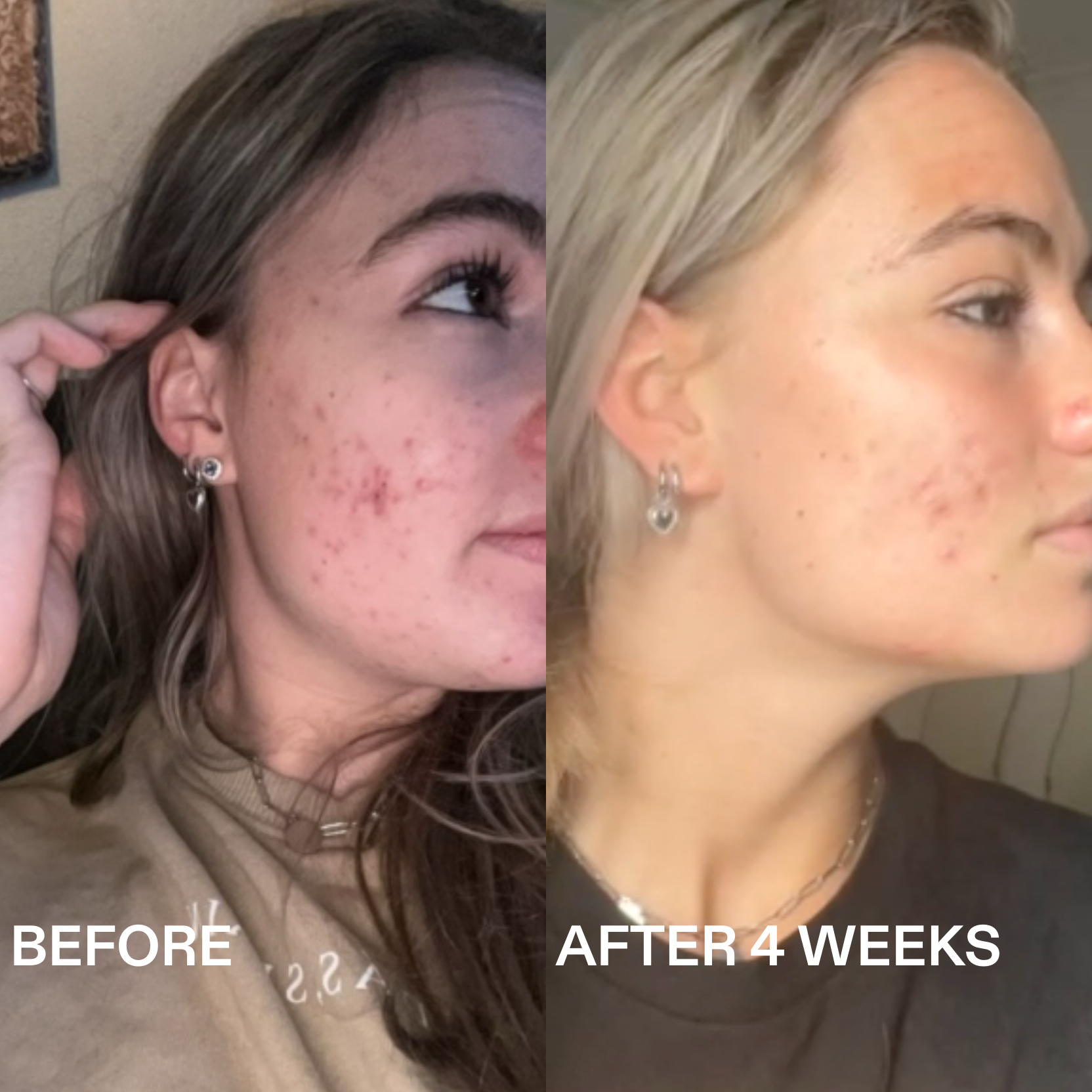 Sérum de Ácido Azelaico 360° Routinely – Piel uniforme y luminosa