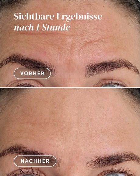 Pad Reutilizable para la Frente con Ectoína – Tratamiento Anti-Edad Intensivo