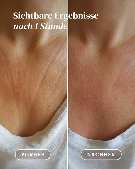 Detalle del pad de silicona de grado médico para cuello y escote con ácido hialurónico